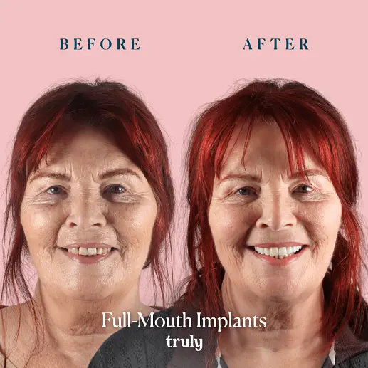 Implants