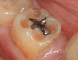 erosive tooth wear