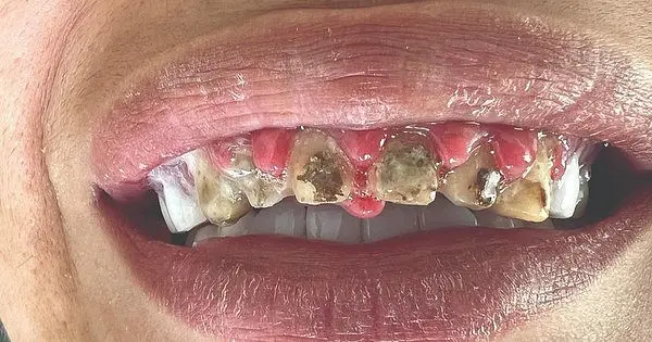 Turkey Teeth Implants: When Cheap Implants Cost More Than You Bargained For
