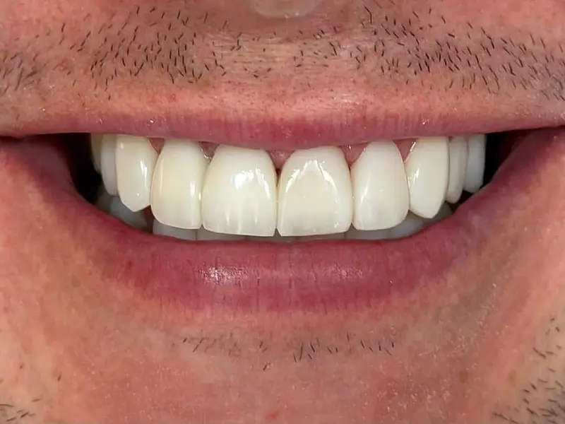 Uniform, natural looking upper smile after composite bonding, DentiCare Dublin 7