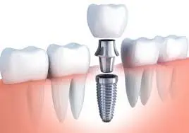Implant