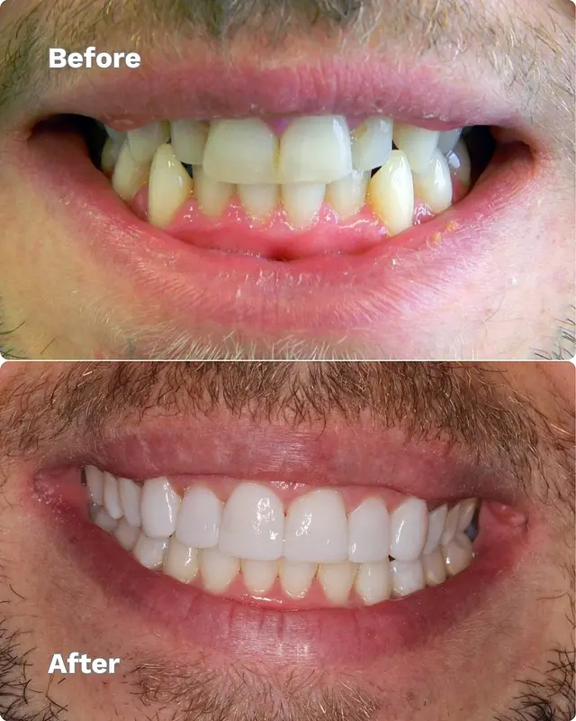 Braces