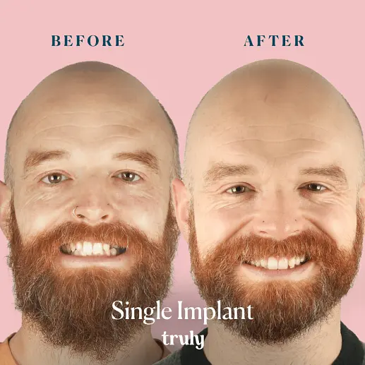 Implants