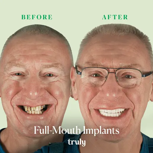 Implants