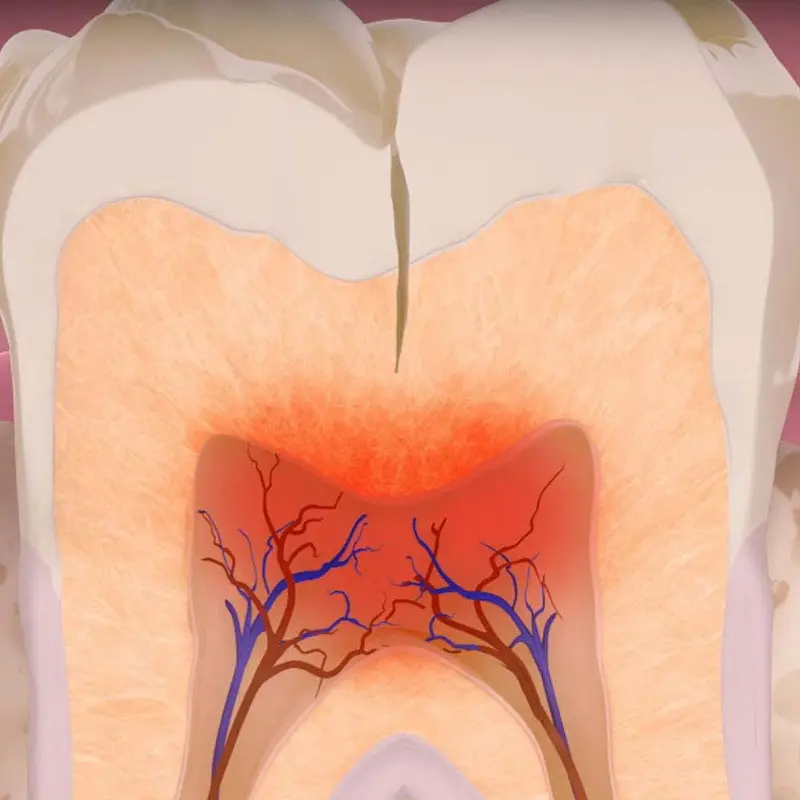 Cracked Teeth