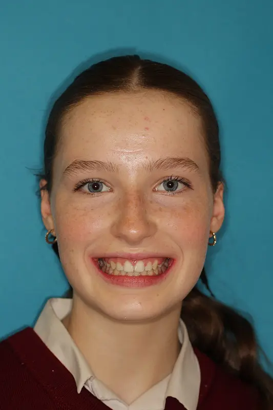 Case Study: Correcting a Severe 10mm Overjet – How Early Intervention Avoided Jaw Surgery
