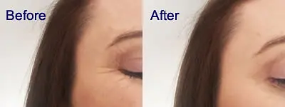 Facial Rejuvenation