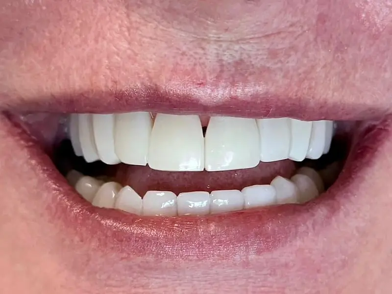 Fuller, brighter front teeth after composite bonding at our Phibsborough clinic