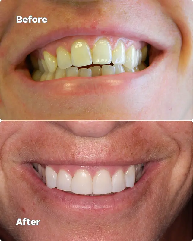 Braces