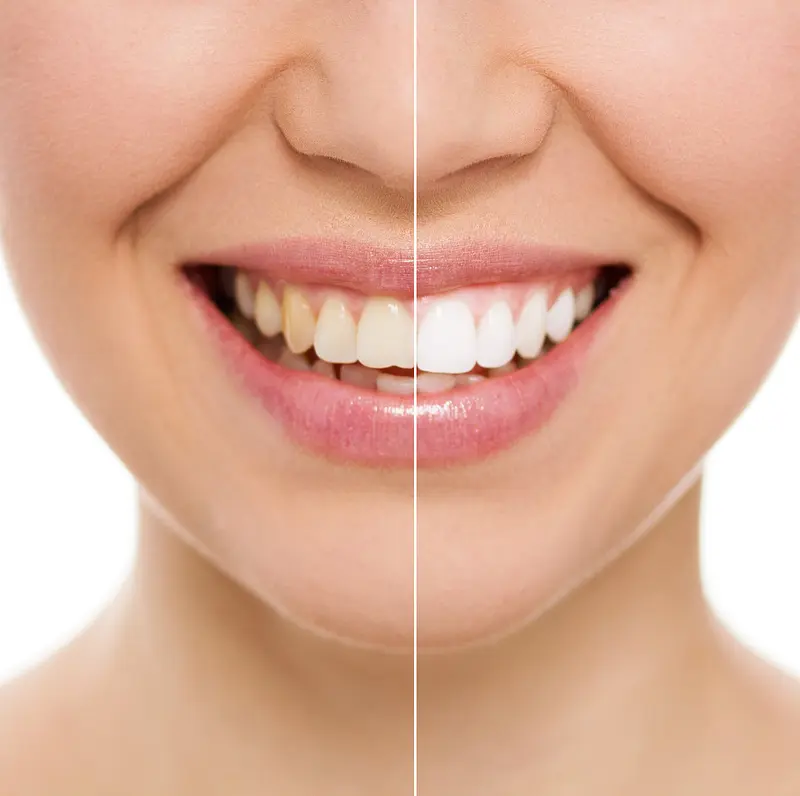 Dentist Limerick | Teeth Whitening | Remove Stains From Teeth | Stain removal