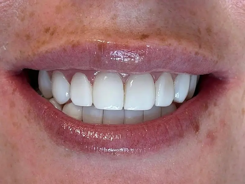 Wider, brighter and evenly spaced smile after composite bonding in Phibsborough, Dublin 7