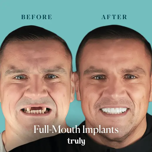 Implants