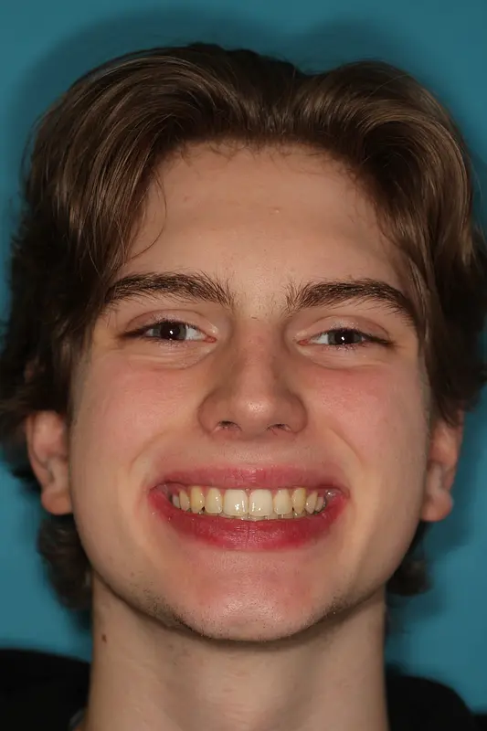Overcoming a Deep Overbite and Managing Bruxism