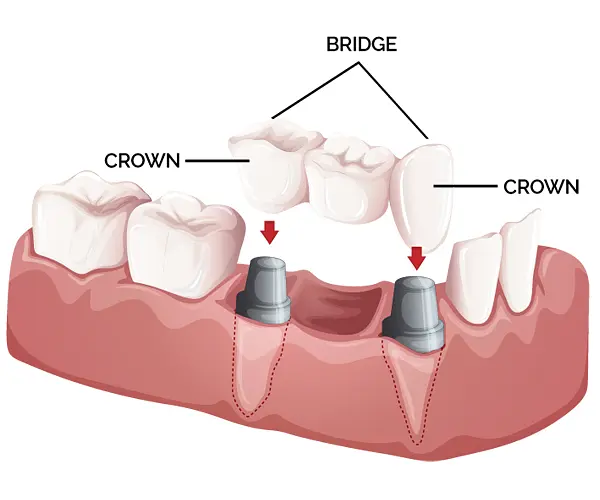 Crown and bridges