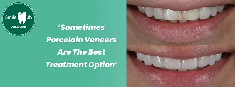 How Long Do Porcelain Veneers Last?