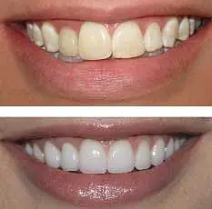 porcelain-veneers.jpg