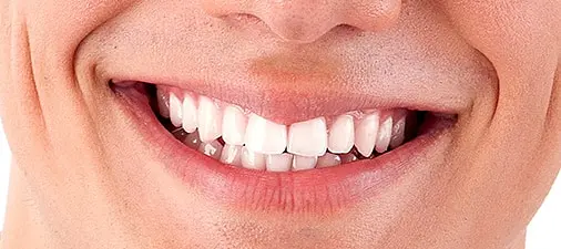 How to Brush Your Teeth Properly