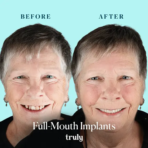 Implants