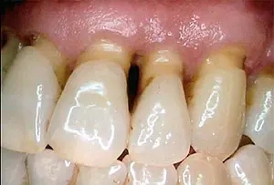 gumdisease resolved