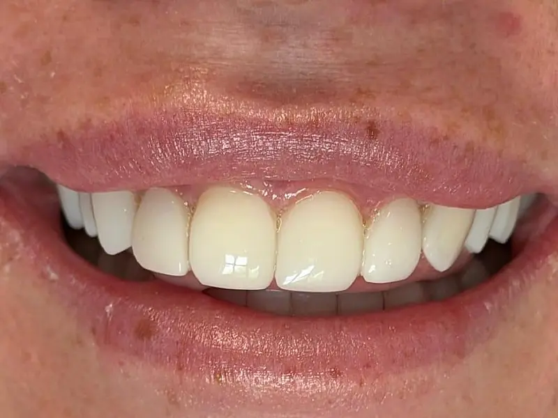 Balanced, evenly shaped smile after composite bonding at DentiCare Phibsborough