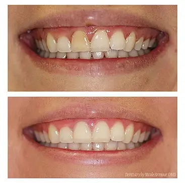 Mastering Colour Matching in Composite Bonding: Crafting a Seamless, Natural Smile