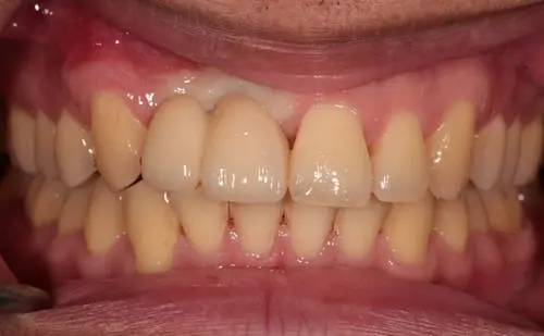 After -Harcourt Dental Clinic