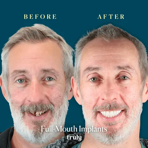 Implants