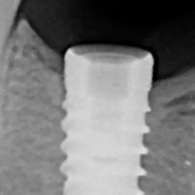 Fractured Implant Screw Removal