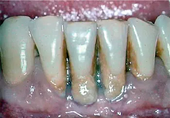 perio disease