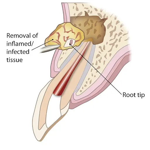 Understanding Apicectomy