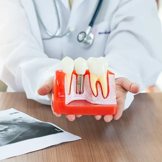 Dental4U Clinic - Dental Implant