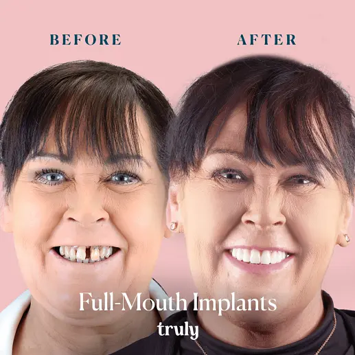 Implants