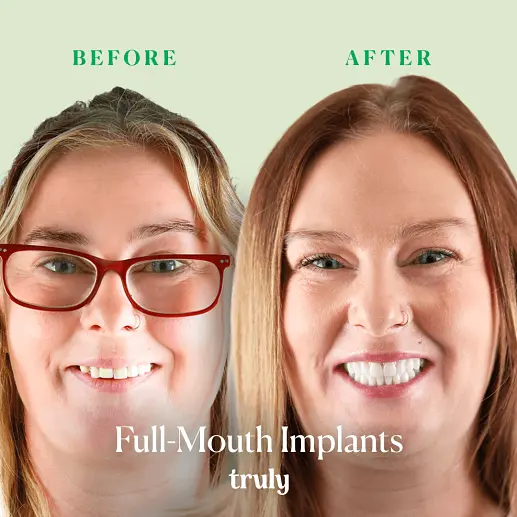 Implants