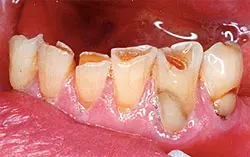 attrition tooth wear