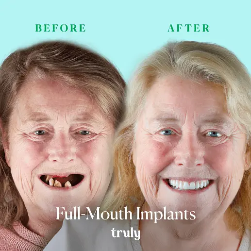 Implants