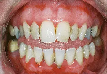 gumdisease