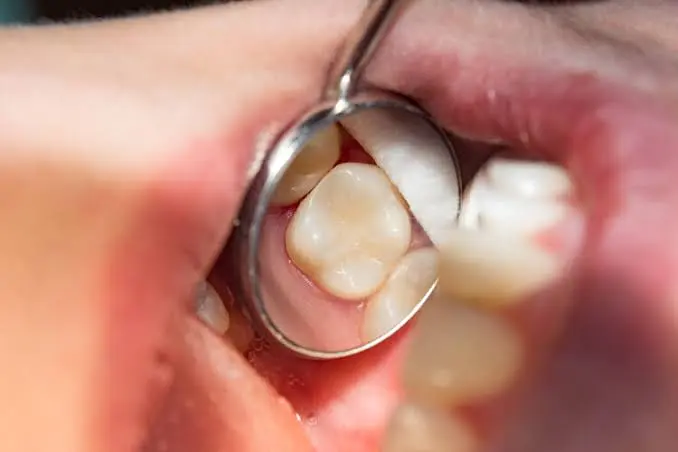 dental fillings in limerick