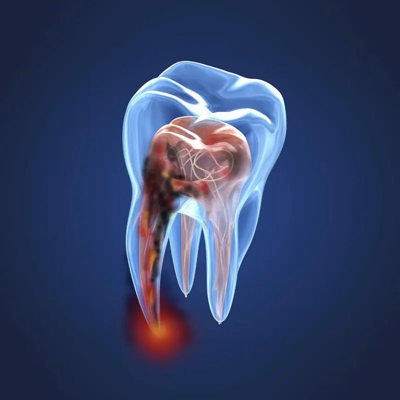 Understanding Root Canal Treatment